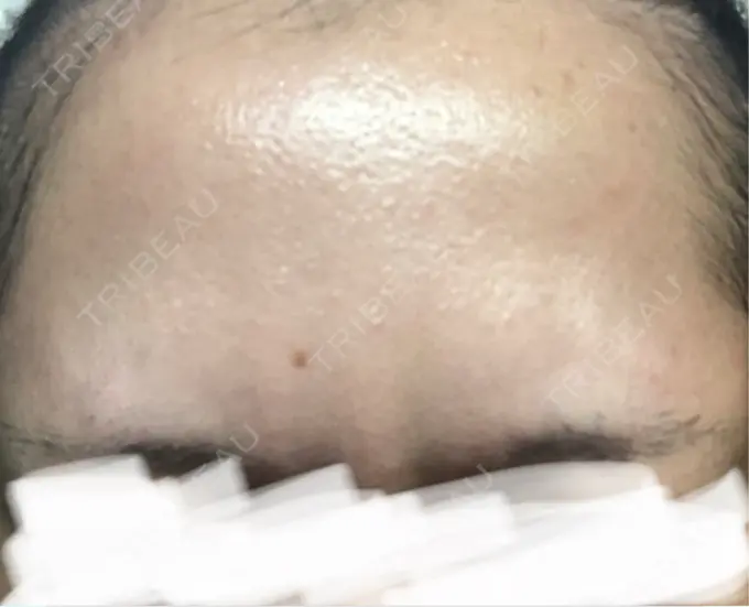 ボトックス（あご） / ボトックス（眉間） / ボトックス（目尻） / ボトックス（額） TCB東京中央美容外科 青森院 DAY 10 メイン用