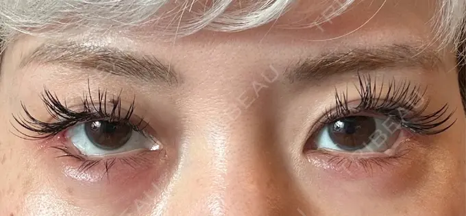 目尻切開 / タレ目形成・グラマラスライン（埋没） LOUIS CLINIC 二子玉川院【ルイクリニック】 DAY 1 メイン用