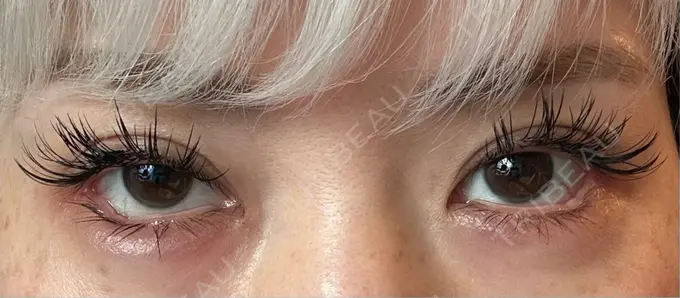 目尻切開 / タレ目形成・グラマラスライン（埋没） LOUIS CLINIC 二子玉川院【ルイクリニック】 DAY 2 メイン用