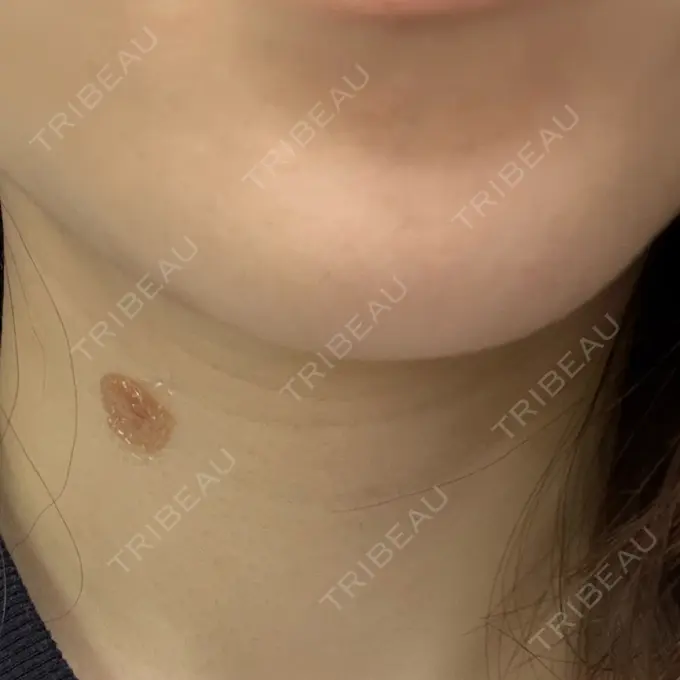 ほくろ・いぼ除去レーザー（肌） PureMe Skin Clinic（ピュアミースキンクリニック麻布） DAY 1 メイン用