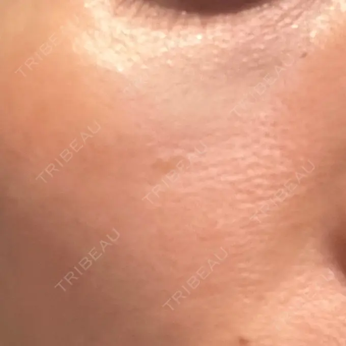 リジュラン 湘南美容クリニック 広島院 DAY 9 メイン用