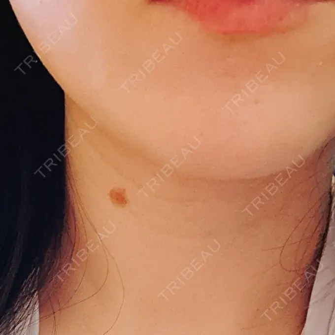 ほくろ・いぼ除去レーザー（肌） PureMe Skin Clinic（ピュアミースキンクリニック麻布） DAY 2 メイン用