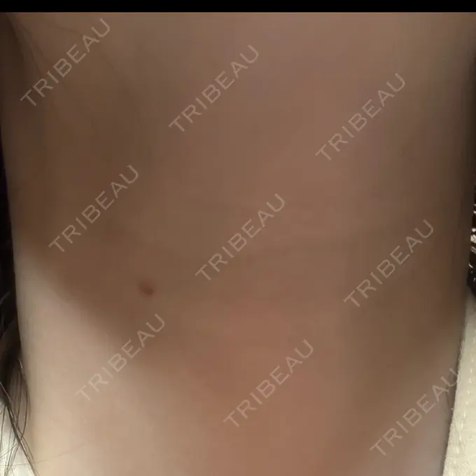 ほくろ・いぼ除去レーザー（肌） PureMe Skin Clinic（ピュアミースキンクリニック麻布） DAY 7 メイン用