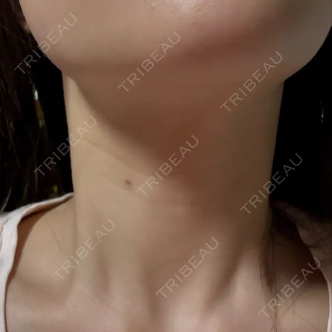 ほくろ・いぼ除去レーザー（肌） PureMe Skin Clinic（ピュアミースキンクリニック麻布） DAY 10 メイン用