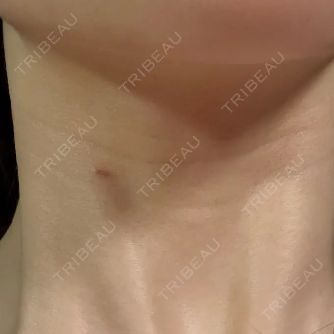 ほくろ・いぼ除去レーザー（肌） PureMe Skin Clinic（ピュアミースキンクリニック麻布） DAY 11 メイン用