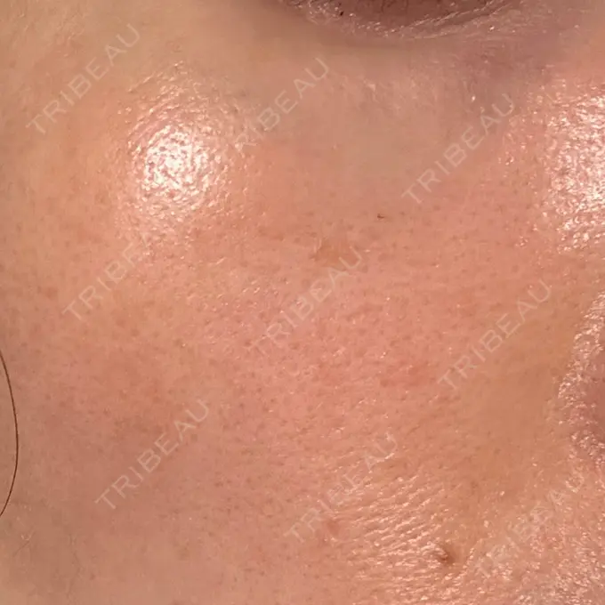 リジュラン 湘南美容クリニック 広島院 DAY 11 メイン用