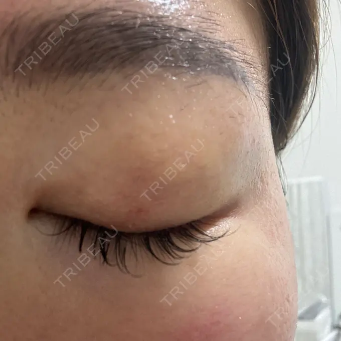 上まぶたの脂肪取り 湘南美容クリニック 大阪四ツ橋院 DAY 4 メイン用