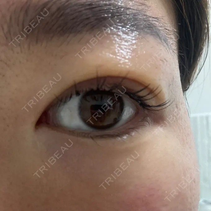 上まぶたの脂肪取り 湘南美容クリニック 大阪四ツ橋院 DAY 4 メイン用