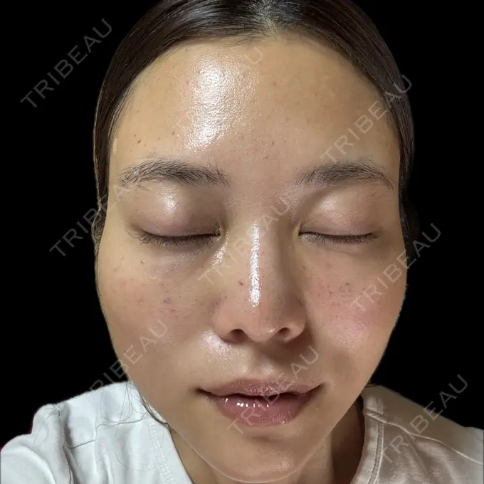 ボトックス（肩） / 肌育注射（ジュベルックなど） APスキンクリニック銀座 DAY 33 メイン用