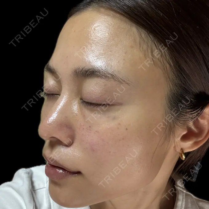 ボトックス（肩） / 肌育注射（ジュベルックなど） APスキンクリニック銀座 DAY 33 メイン用