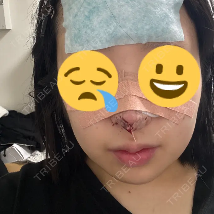 鼻尖形成（切開） / 鼻尖縮小 東京シンデレラ美容外科 大宮院 AFTER メイン用