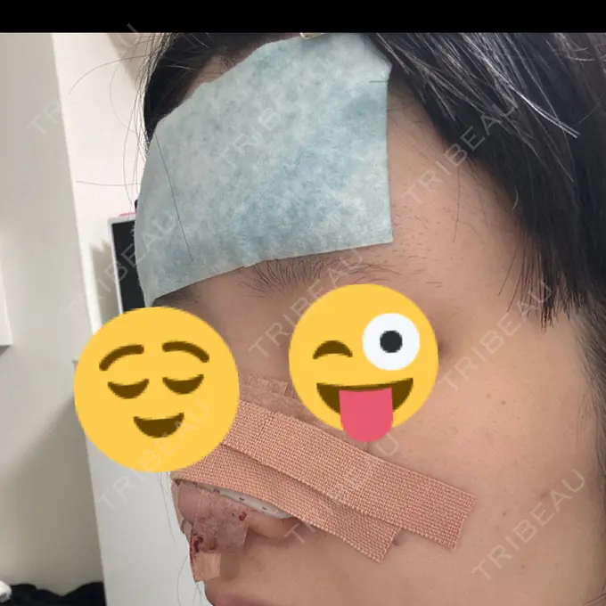 鼻尖形成（切開） / 鼻尖縮小 東京シンデレラ美容外科 大宮院 DAY 0 メイン用