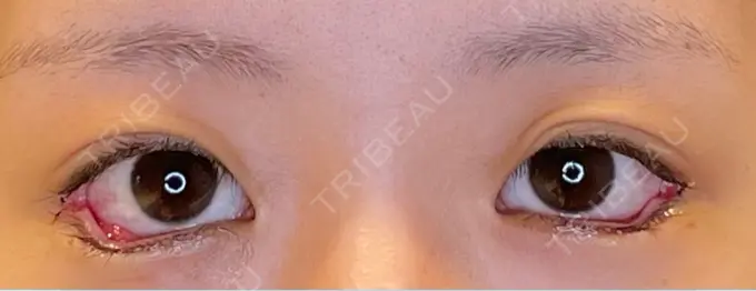 目尻切開 / タレ目形成・グラマラスライン（埋没） LOUIS CLINIC 二子玉川院【ルイクリニック】 DAY 0 メイン用