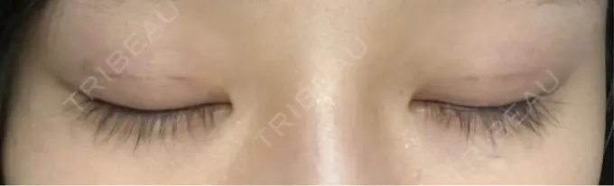 二重埋没 恵聖会クリニック 京橋院 DAY 7 メイン用