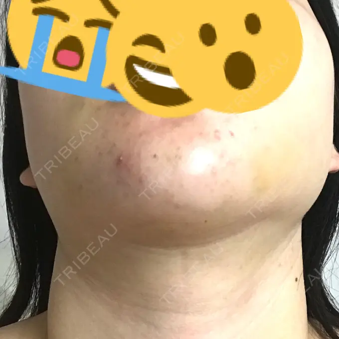 バッカルファット除去 / 脂肪吸引（顔） / ヒアルロン酸注入（鼻） / ボトックス（あご） / 水光注射（ハリ・美肌） / ヒアルロン酸注入（あご） / ボトックス（エラ・小顔） / 白玉点滴・注射 エートップ美容整形外科 DAY 7 メイン用