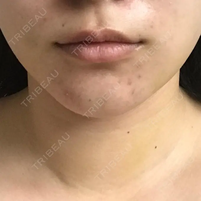 バッカルファット除去 / 脂肪吸引（顔） / ヒアルロン酸注入（鼻） / ボトックス（あご） / 水光注射（ハリ・美肌） / ヒアルロン酸注入（あご） / ボトックス（エラ・小顔） / 白玉点滴・注射 エートップ美容整形外科 DAY 7 メイン用