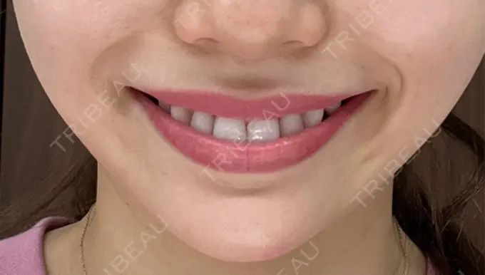 ボトックス（口角） ルラ美容クリニック 広島院 DAY 12 メイン用