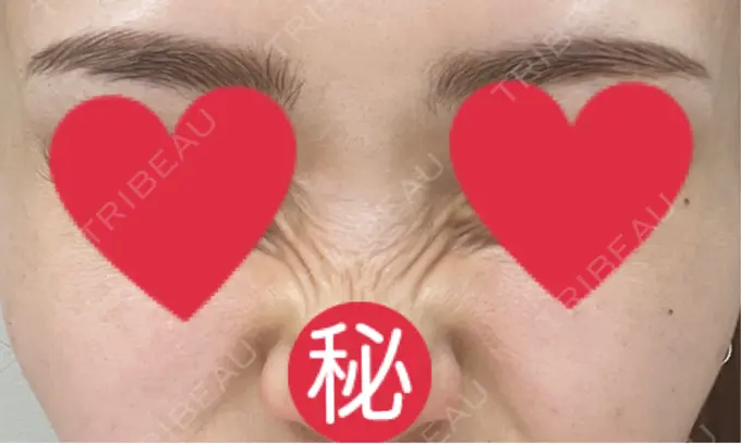 ボトックス（バニーライン） 共立美容外科 広島院 DAY 9 メイン用