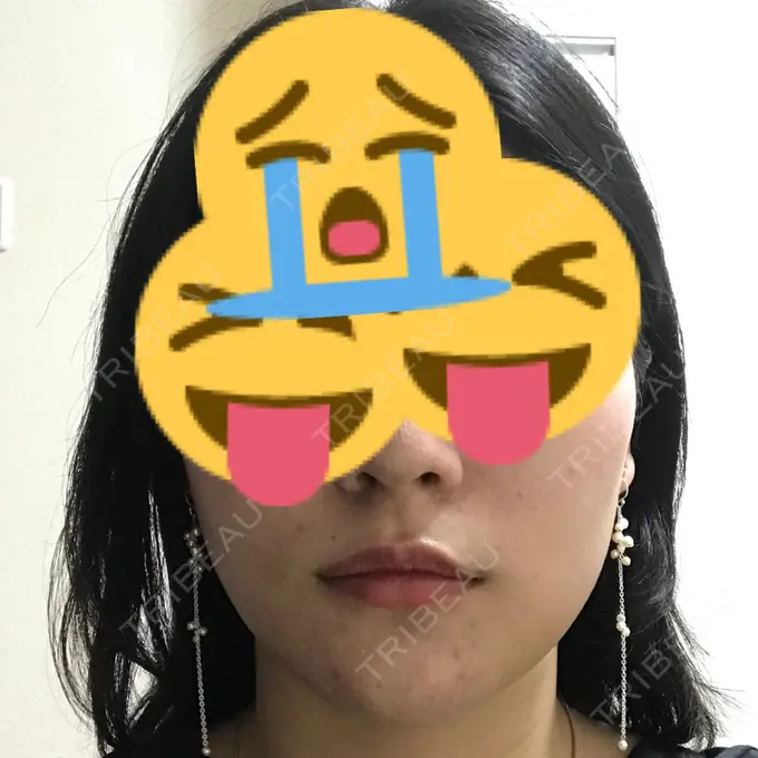 バッカルファット除去 / 脂肪吸引（顔） / ヒアルロン酸注入（鼻） / ボトックス（あご） / 水光注射（ハリ・美肌） / ヒアルロン酸注入（あご） / ボトックス（エラ・小顔） / 白玉点滴・注射 エートップ美容整形外科 DAY 7 メイン用