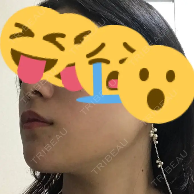 バッカルファット除去 / 脂肪吸引（顔） / ヒアルロン酸注入（鼻） / ボトックス（あご） / 水光注射（ハリ・美肌） / ヒアルロン酸注入（あご） / ボトックス（エラ・小顔） / 白玉点滴・注射 エートップ美容整形外科 DAY 7 メイン用