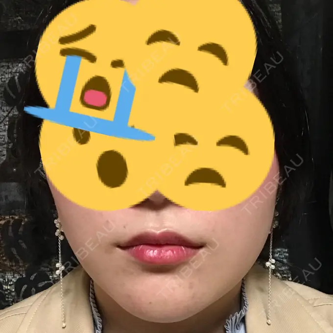 バッカルファット除去 / 脂肪吸引（顔） / ヒアルロン酸注入（鼻） / ボトックス（あご） / 水光注射（ハリ・美肌） / ヒアルロン酸注入（あご） / ボトックス（エラ・小顔） / 白玉点滴・注射 エートップ美容整形外科 DAY 9 メイン用