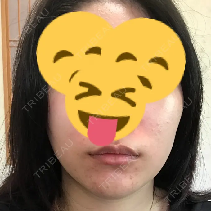 バッカルファット除去 / 脂肪吸引（顔） / ヒアルロン酸注入（鼻） / ボトックス（あご） / 水光注射（ハリ・美肌） / ヒアルロン酸注入（あご） / ボトックス（エラ・小顔） / 白玉点滴・注射 エートップ美容整形外科 DAY 10 メイン用