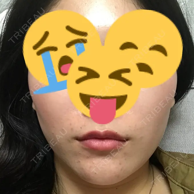 バッカルファット除去 / 脂肪吸引（顔） / ヒアルロン酸注入（鼻） / ボトックス（あご） / 水光注射（ハリ・美肌） / ヒアルロン酸注入（あご） / ボトックス（エラ・小顔） / 白玉点滴・注射 エートップ美容整形外科 DAY 24 メイン用