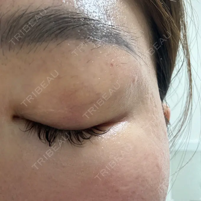 上まぶたの脂肪取り 湘南美容クリニック 大阪四ツ橋院 DAY 5 メイン用