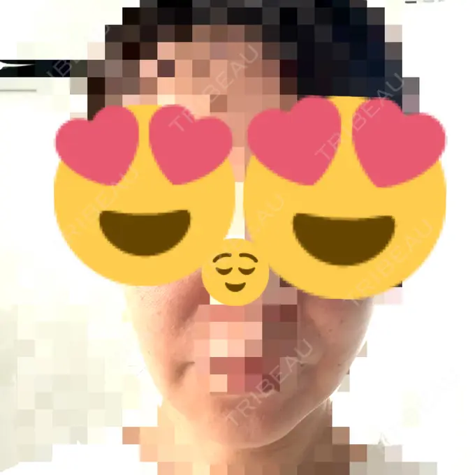 糸リフト アリエル美容クリニック 横浜院 DAY 13 メイン用