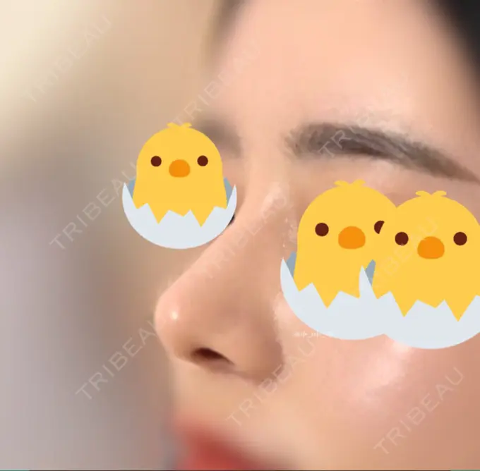 鼻尖形成（切開） / 鼻中隔延長（切開） / 軟骨移植 / 眉間プロテーゼ / 鼻修正 ミナ美容外科 DAY 91 メイン用