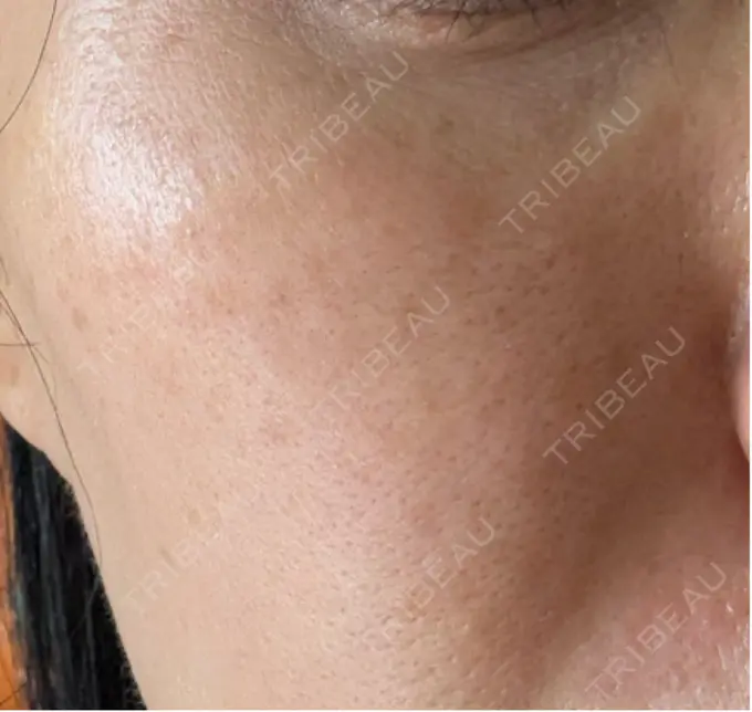 イオン導入 / ピーリング（ハリ・ツヤ） / ルメッカ ルラ美容クリニック 名古屋栄院 / ルラスキンクリニック 名古屋栄院 DAY 4 メイン用