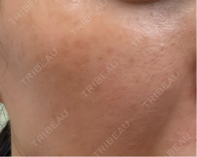 イオン導入 / ピーリング（ハリ・ツヤ） / ルメッカ ルラ美容クリニック 名古屋栄院 / ルラスキンクリニック 名古屋栄院 DAY 6 メイン用