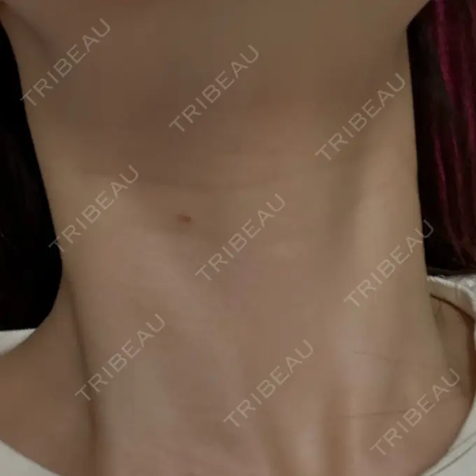 ほくろ・いぼ除去レーザー（肌） PureMe Skin Clinic（ピュアミースキンクリニック麻布） AFTER メイン用