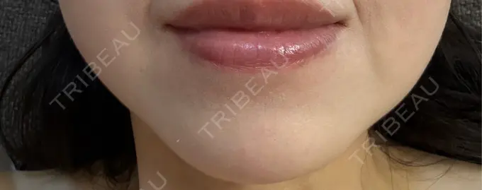 ボトックス（あご） Belle Via Skin Clinic DAY 9 メイン用