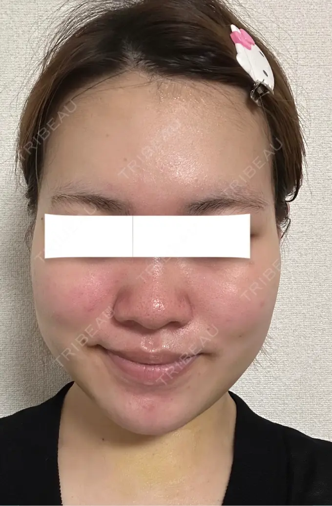 糸リフト / 脂肪吸引（顔） / ジョールファット除去 / 脂肪吸引注射（顔） / ボトックス（エラ・小顔） SEA CLINIC（シークリニック） DAY 4 メイン用