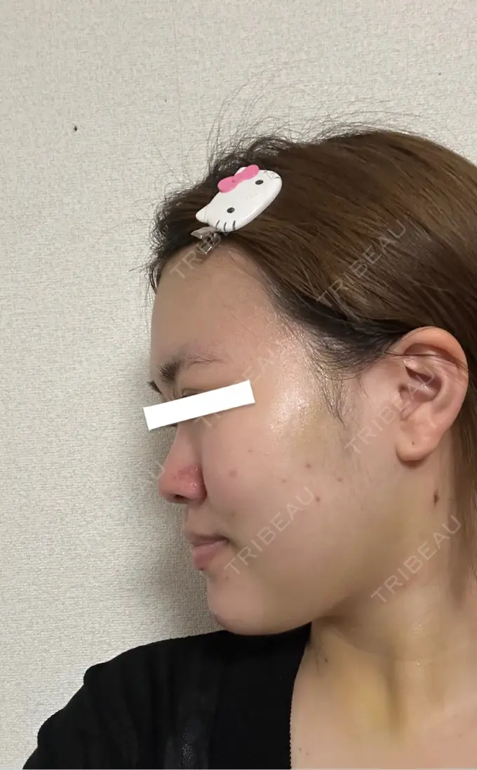 糸リフト / 脂肪吸引（顔） / ジョールファット除去 / 脂肪吸引注射（顔） / ボトックス（エラ・小顔） SEA CLINIC（シークリニック） DAY 4 メイン用