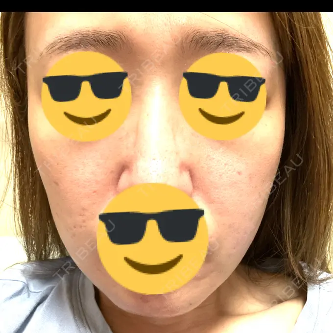 肌育注射（ジュベルックなど） / その他（肌） ゆきスキンクリニック 東池袋 AFTER メイン用