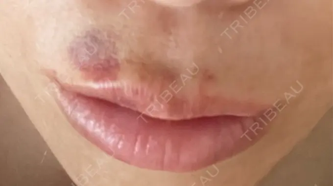 クマ治療 / 下まぶたの脂肪取り / ヒアルロン酸注入（唇） / ボトックス（口角） TCB東京中央美容外科 仙台駅前院 DAY 4 メイン用