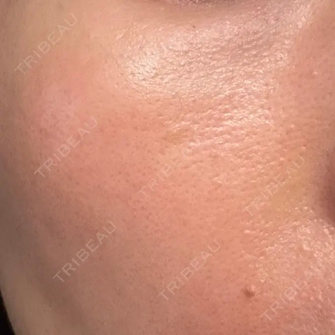 リジュラン 湘南美容クリニック 広島院 DAY 13 メイン用