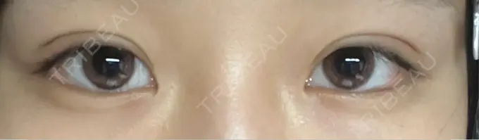 二重埋没 恵聖会クリニック 京橋院 DAY 8 メイン用