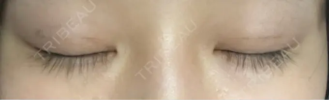 二重埋没 恵聖会クリニック 京橋院 DAY 8 メイン用