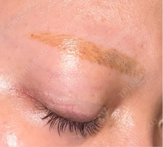 アートメイク除去・修正 ライズワン美容皮膚科クリニック DAY 4 メイン用