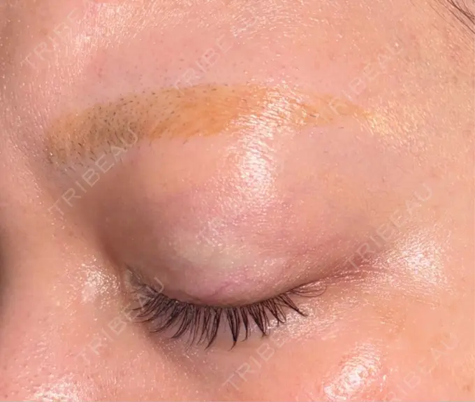 アートメイク除去・修正 ライズワン美容皮膚科クリニック DAY 4 メイン用