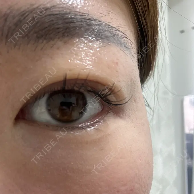 上まぶたの脂肪取り 湘南美容クリニック 大阪四ツ橋院 DAY 6 メイン用