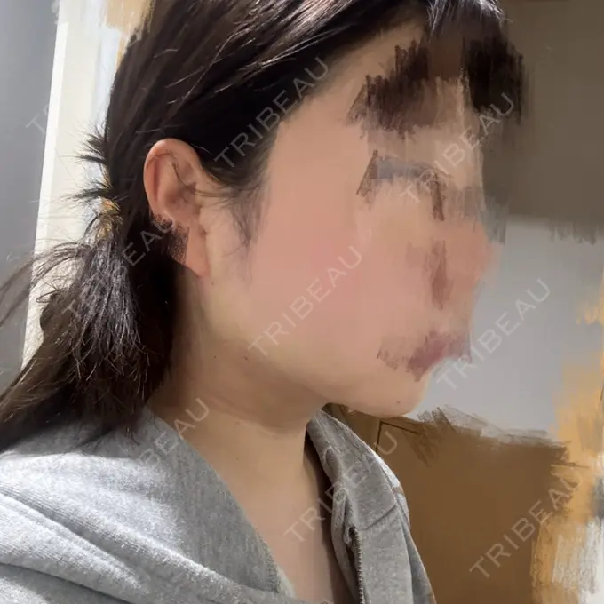 脂肪吸引（顔） THE CLINIC（ザ・クリニック） 福岡院 DAY 1 メイン用