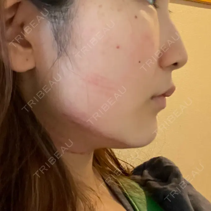 RF（高周波）たるみ治療 BITO BEAUTY CLINIC DAY 0 メイン用