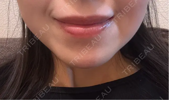 ボトックス（あご） Belle Via Skin Clinic DAY 10 メイン用