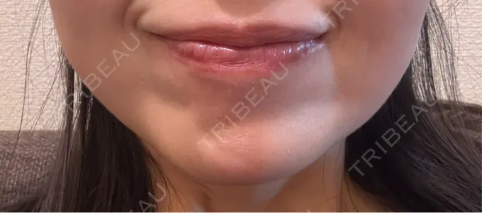 ボトックス（あご） Belle Via Skin Clinic DAY 10 メイン用