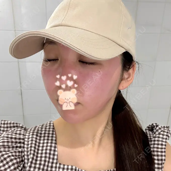 ピーリング（ニキビ・毛穴） / ダーマペン / ピーリング（ハリ・ツヤ） / ミラノリピール DAILY SKIN CLINIC 心斎橋院 DAY 0 メイン用