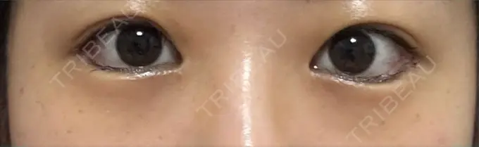 目尻切開 / タレ目形成・グラマラスライン（埋没） LOUIS CLINIC 二子玉川院【ルイクリニック】 DAY 2 メイン用